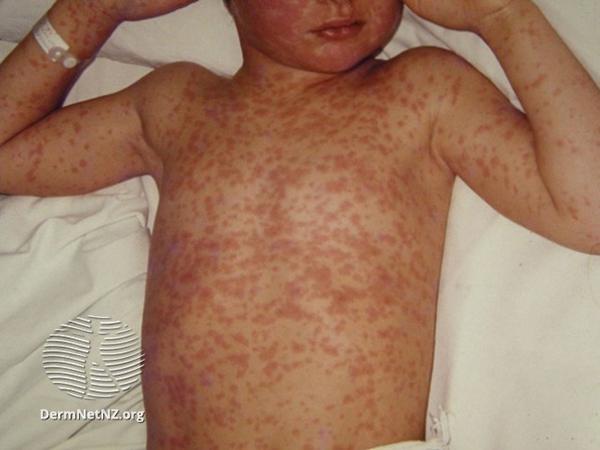 Mexico Registers 185 New Measles Cases During Opening Week of the World Cup